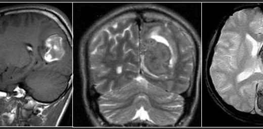 دانلود پاورپوینت ارزیابی خونریزی های مغزی در MRI